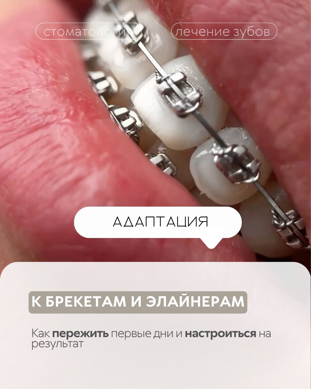 Брекеты и элайнеры — фото 1, клиника TopStom