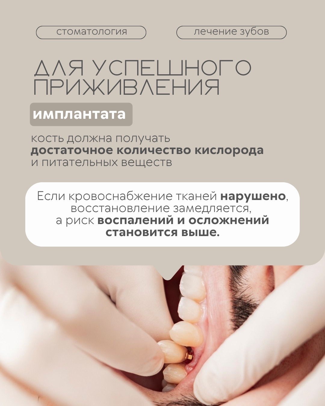Имплантация зубов — фото 2, клиника TopStom
