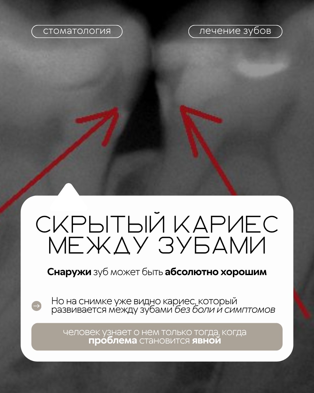 Лечение зубов — фото 2, клиника TopStom